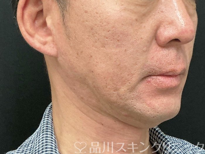 症例NO.73926のBEFORE写真