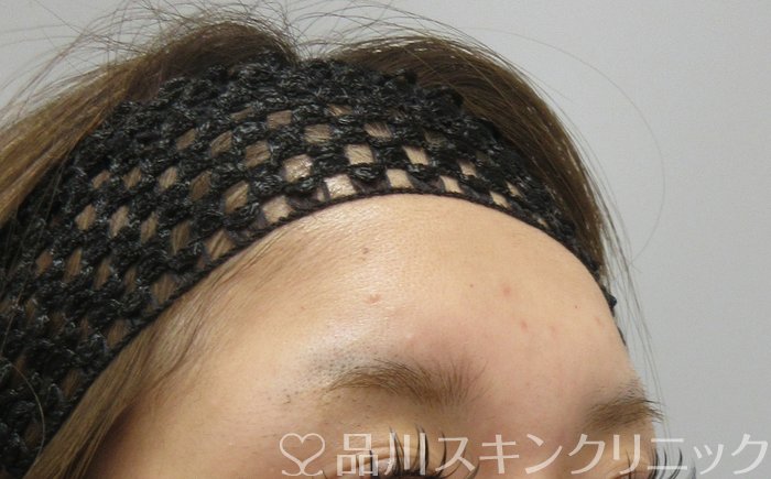症例NO.74522のBEFORE写真