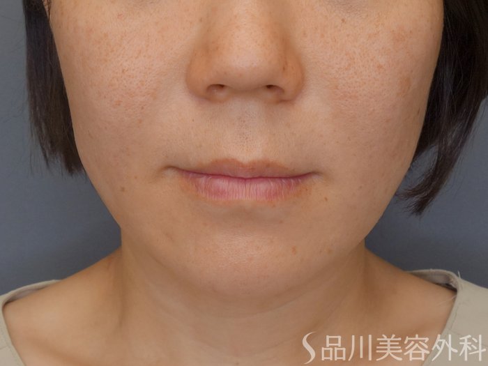 症例NO.70359のBEFORE写真