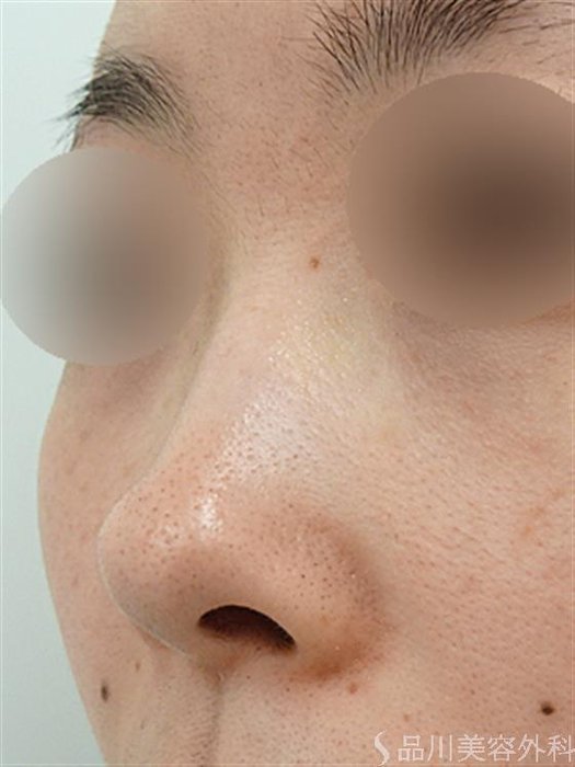 症例NO.44532のBEFORE写真