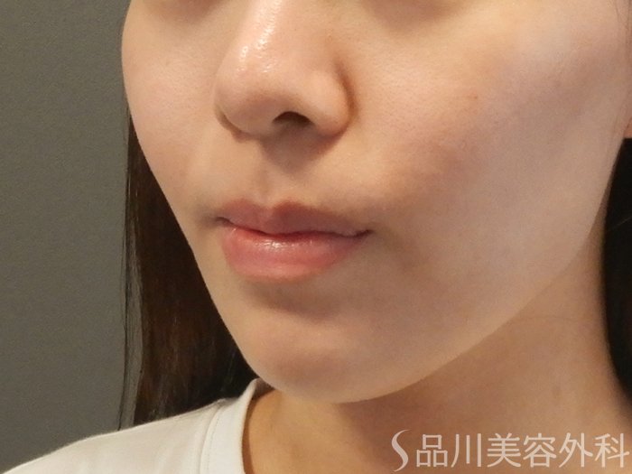 症例NO.67458のBEFORE写真