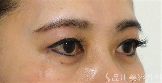 症例NO.47297のAFTER写真