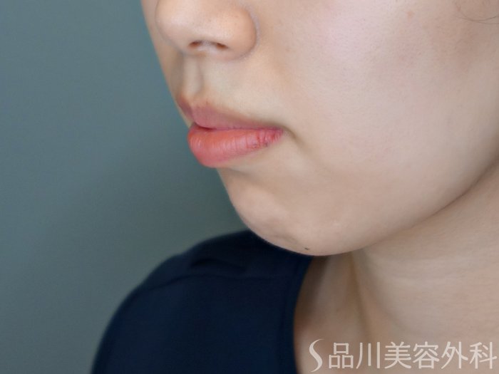 症例NO.70090のBEFORE写真