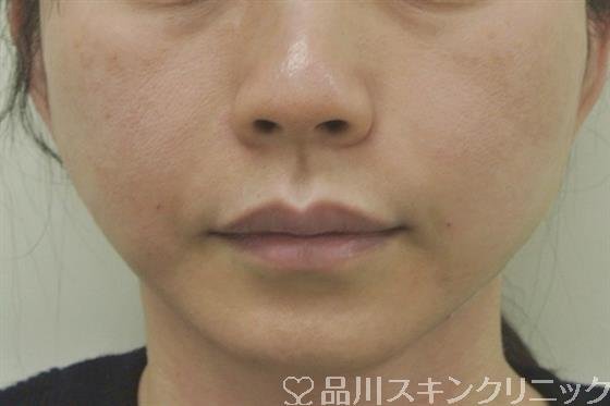 症例NO.33726のAFTER写真