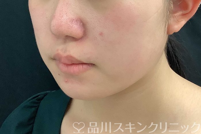 症例NO.69778のAFTER写真