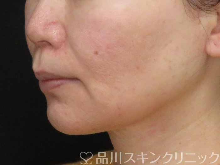 症例NO.67944のBEFORE写真