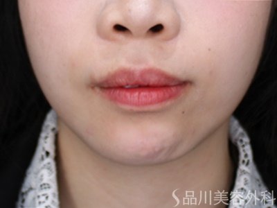 症例NO.72256のAFTER写真