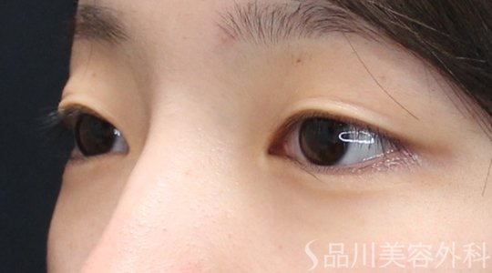 症例NO.74902のBEFORE写真