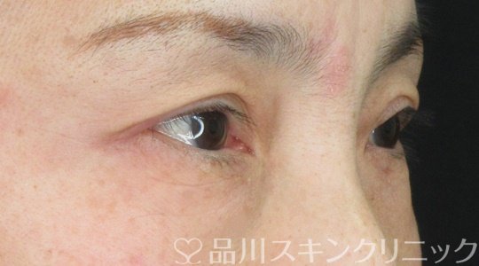 症例NO.69039のBEFORE写真