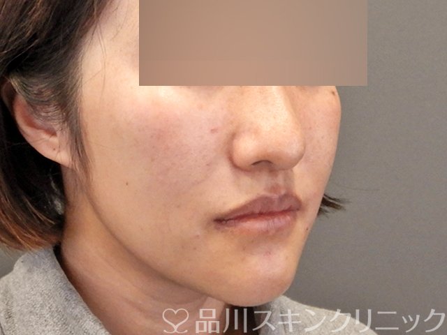 症例NO.69998のAFTER写真