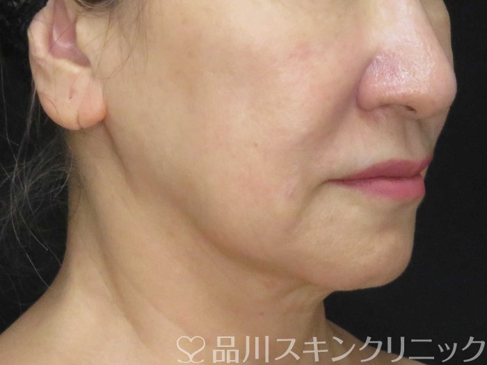 症例NO.65122のBEFORE写真