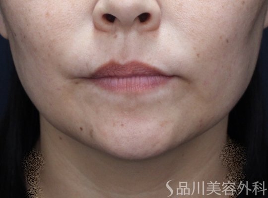 症例NO.71938のAFTER写真