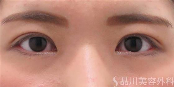 症例NO.45345のAFTER写真
