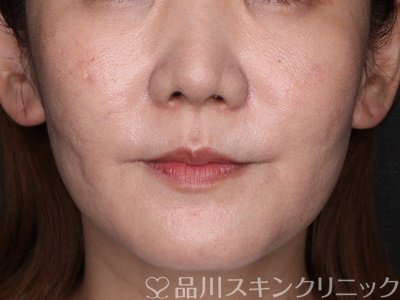 症例NO.72217のAFTER写真