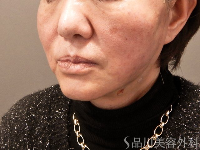 症例NO.69432のAFTER写真
