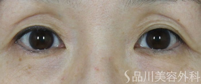 症例NO.66955のBEFORE写真