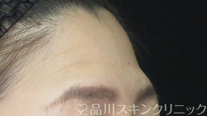 症例NO.71933のBEFORE写真