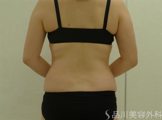 症例NO.50430のAFTER写真