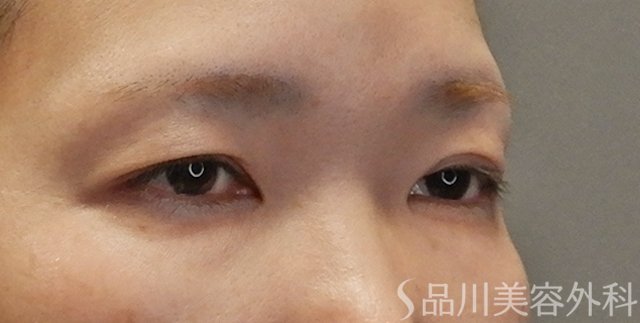 症例NO.75109のBEFORE写真