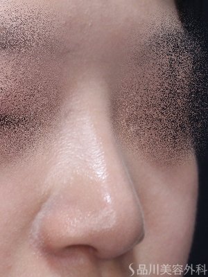 症例NO.71041のAFTER写真