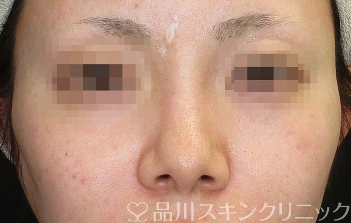 症例NO.73064のBEFORE写真