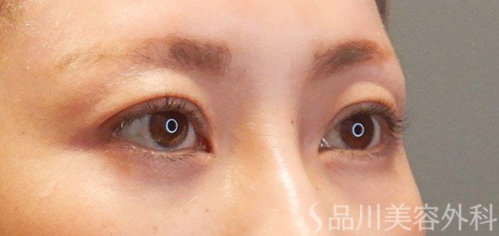 症例NO.71405のAFTER写真