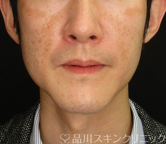 症例NO.73676のBEFORE写真