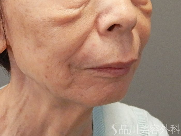 症例NO.70358のAFTER写真