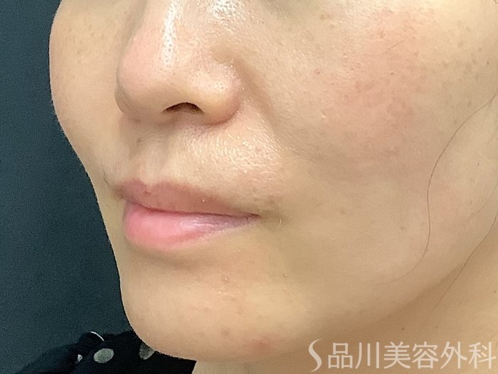症例NO.67655のBEFORE写真