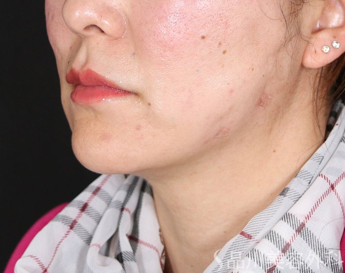 症例NO.73611のAFTER写真