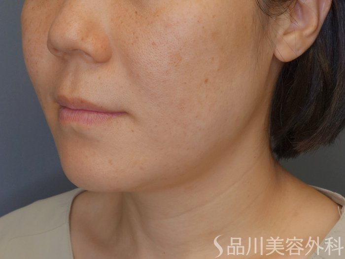 症例NO.70359のBEFORE写真
