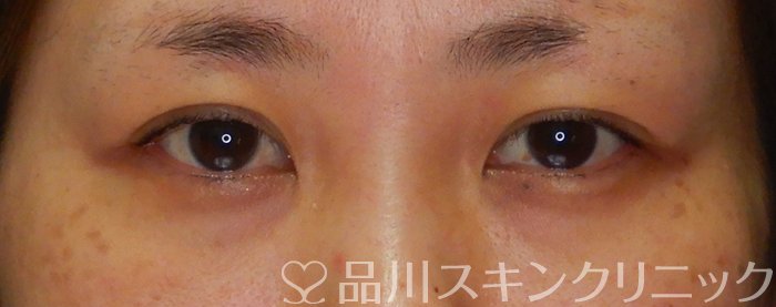 症例NO.64889のBEFORE写真