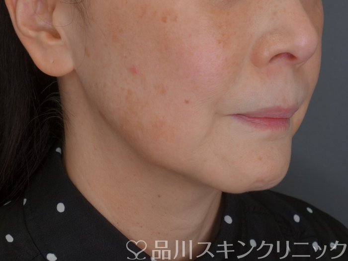 症例NO.72602のBEFORE写真