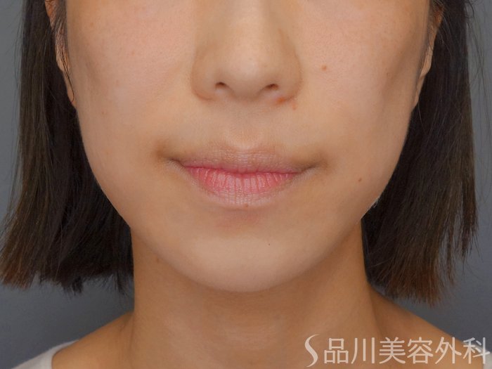 症例NO.72912のAFTER写真