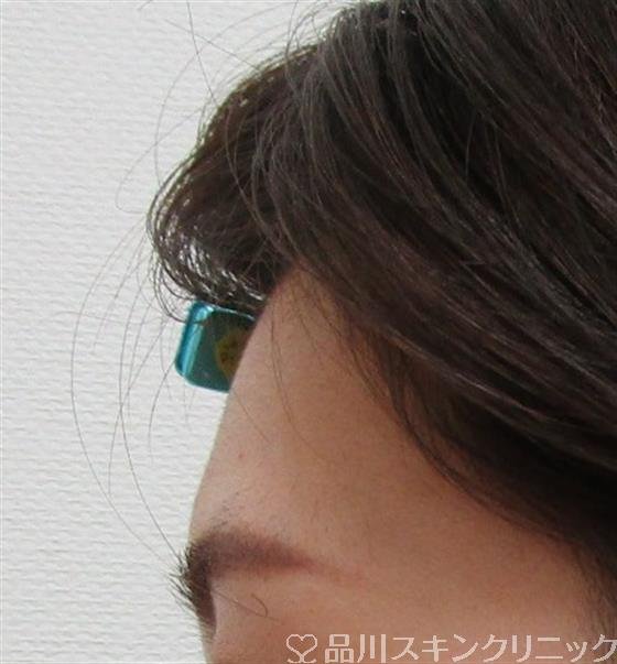 症例NO.32055のBEFORE写真