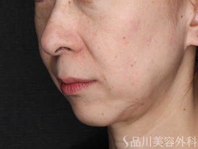 症例NO.73905のBEFORE写真
