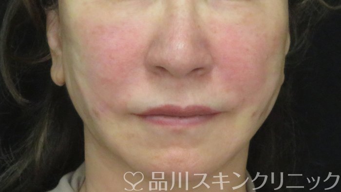 症例NO.71887のAFTER写真