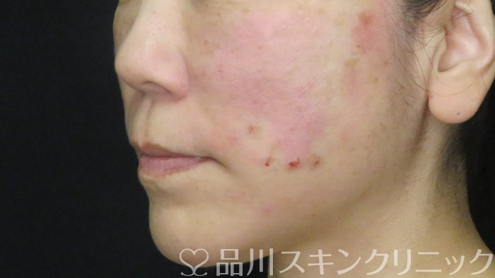 症例NO.71922のAFTER写真