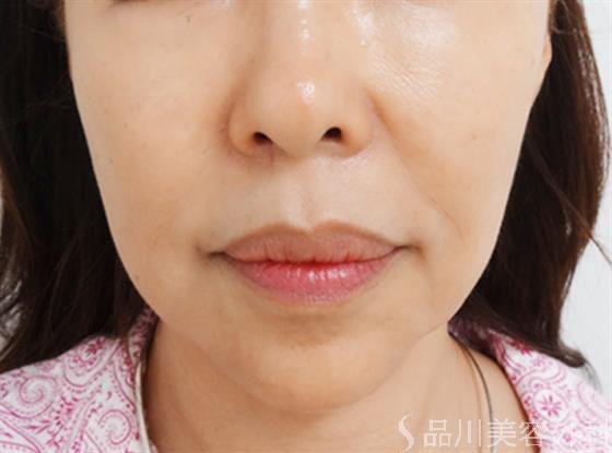 症例NO.24293のBEFORE写真