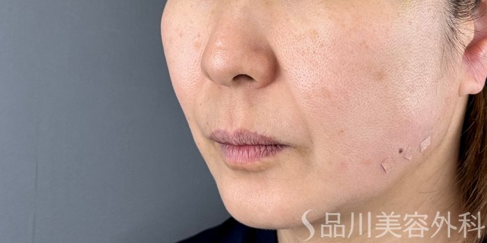 症例NO.71410のAFTER写真