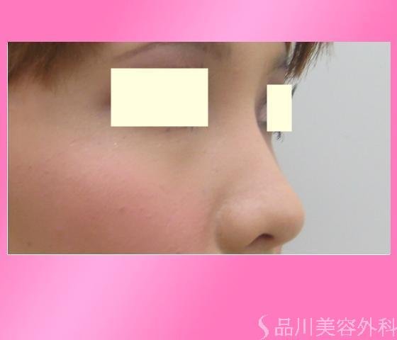 症例NO.3241のBEFORE写真
