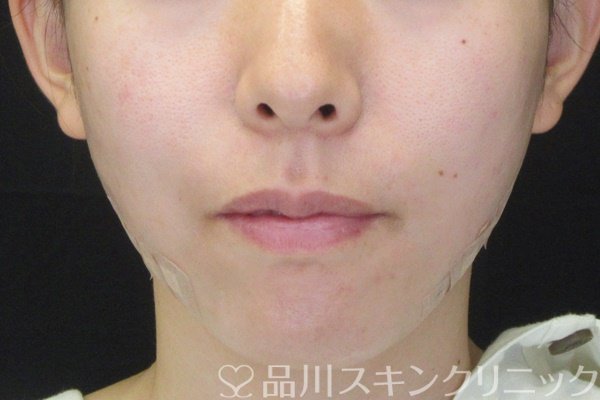 症例NO.64758のAFTER写真