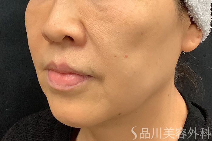 症例NO.73309のBEFORE写真