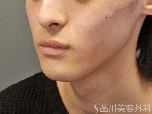 症例NO.73862のAFTER写真