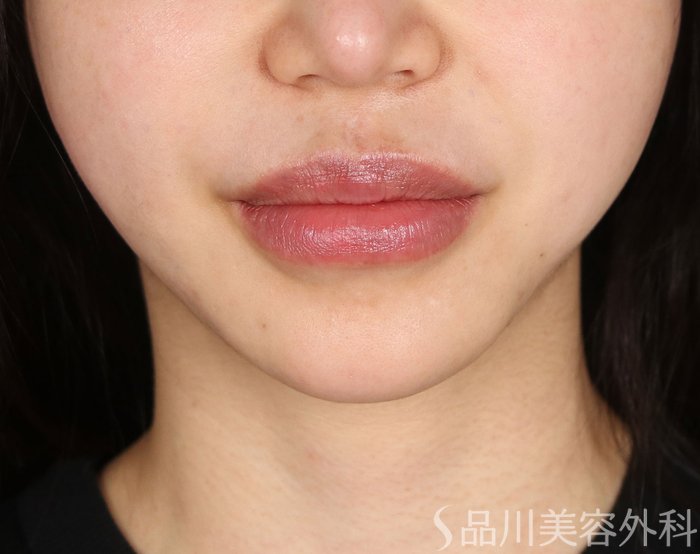 症例NO.73455のAFTER写真