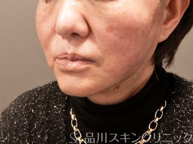 症例NO.69432のAFTER写真