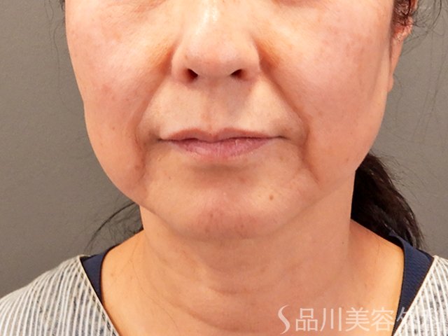 症例NO.70433のBEFORE写真