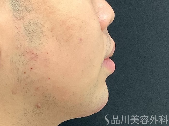 症例NO.67909のAFTER写真
