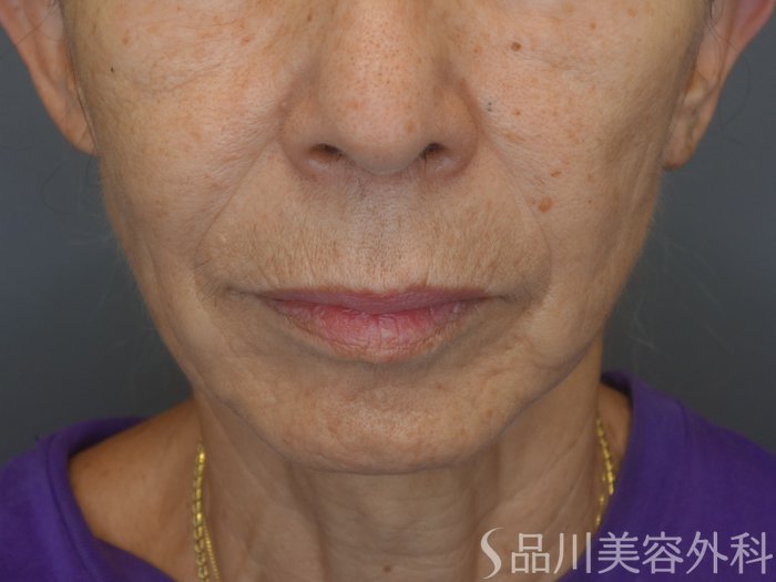 症例NO.69381のBEFORE写真
