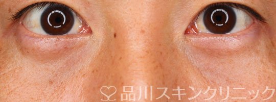 症例NO.75383のAFTER写真